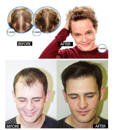 5 Pack Hair Growth Serum, Hair Regrowth Oil Hair Thinning Treatment